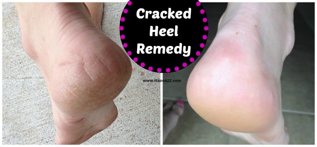 Cracked Heel Remedy